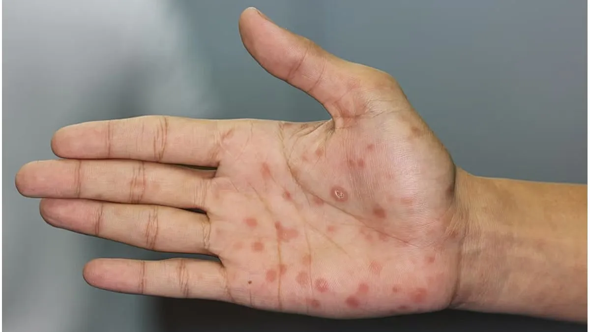 Alerta epidemiológica por sífilis: La infección creció un 47% en Entre Ríos y afecta principalmente a jóvenes de entre 14 y 26 años